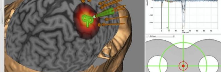 neuronavegador Unicamp