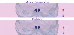 CEPID BRAINN - Hypothalamus Segmentation Challenge